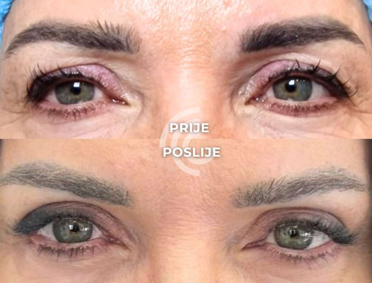 Blefaroplastika: osvježite pogled uz operaciju kapaka koja vraća odmoran i prirodan izgled