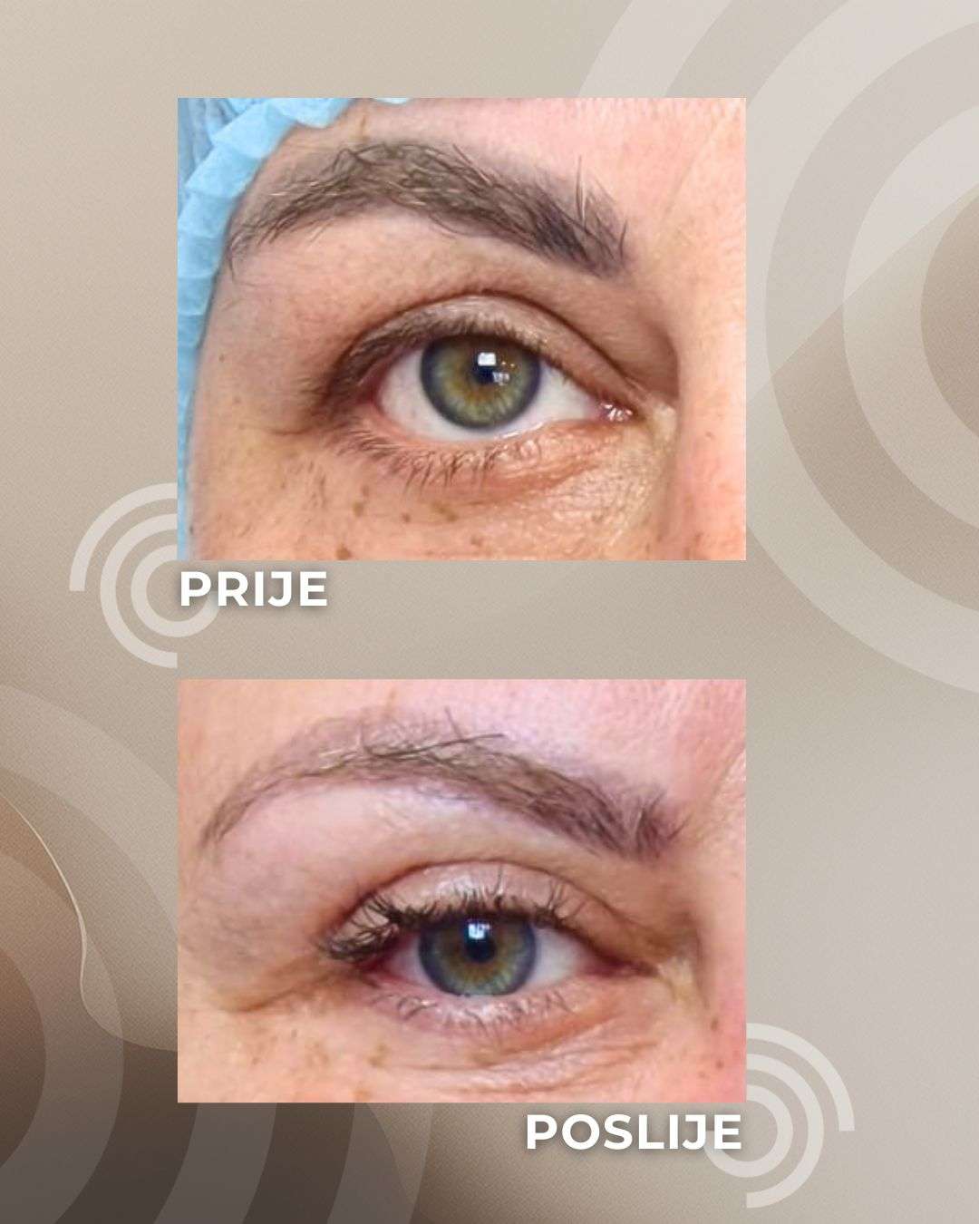 Blefaroplastika: osvježite pogled uz operaciju kapaka koja vraća odmoran i prirodan izgled - 