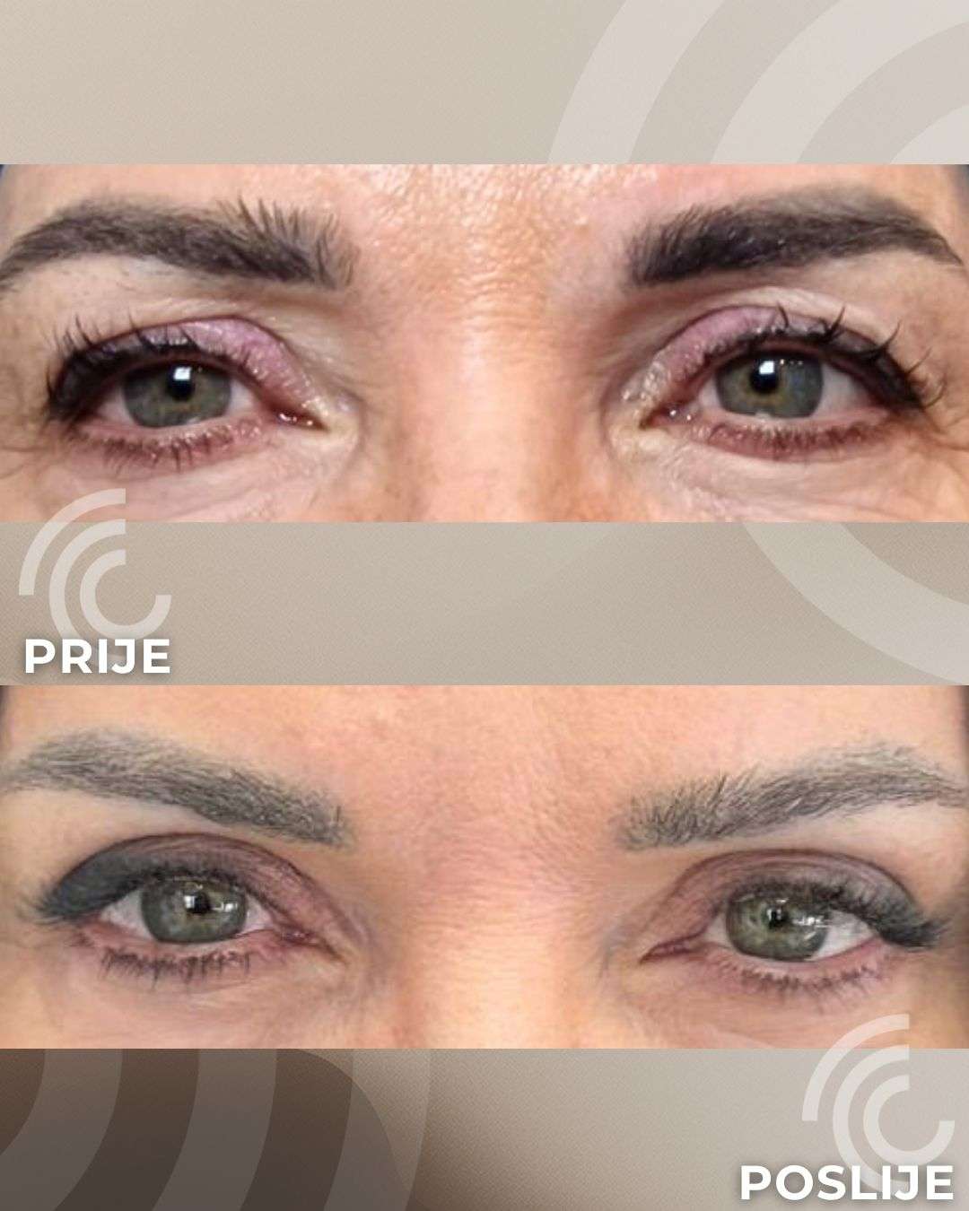 Blefaroplastika: osvježite pogled uz operaciju kapaka koja vraća odmoran i prirodan izgled - 